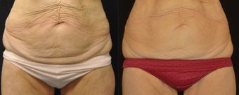 VelaShape III for skin laxity before 1174582