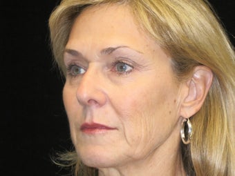 65-74 year old woman treated with Liquid Facelift 3502600