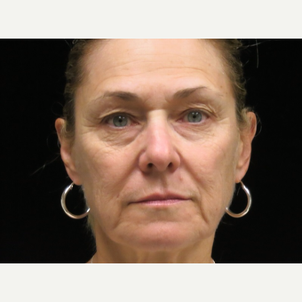 65-74 year old woman treated with Liquid Facelift before 3502600