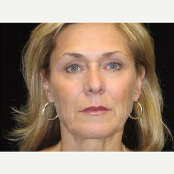 65-74 year old woman treated with Liquid Facelift after 3502600