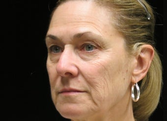 65-74 year old woman treated with Liquid Facelift 3502600