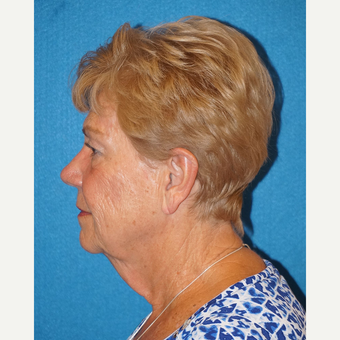 72 year old woman treated with Facelift before 3576584