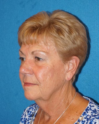 72 year old woman treated with Facelift 3576584