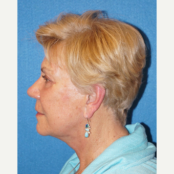 72 year old woman treated with Facelift after 3576584