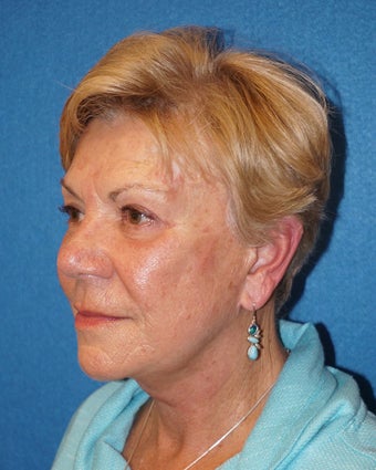 72 year old woman treated with Facelift 3576584