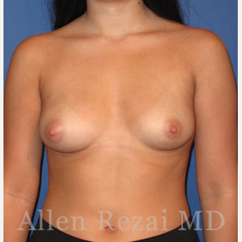 Bilateral Breast Augmentation & Correction of size Asymmetry - Pre- & 4 Weeks Post-op before 3473920