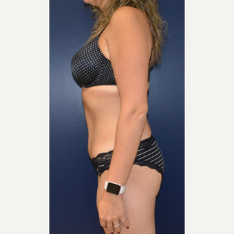 35-44 year old woman treated with Tummy Tuck after 3489830