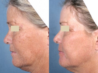 Laser Resurfacing before 104661