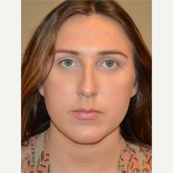 25-34 year old woman treated with Rhinoplasty before 3657946