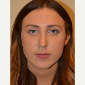 25-34 year old woman treated with Rhinoplasty after 3657946