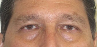 56 year old Asian male who underwent upper lid blepharoplasty surgery after 811464
