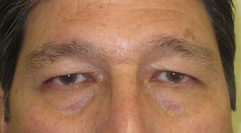 56 year old Asian male who underwent upper lid blepharoplasty surgery before 811464
