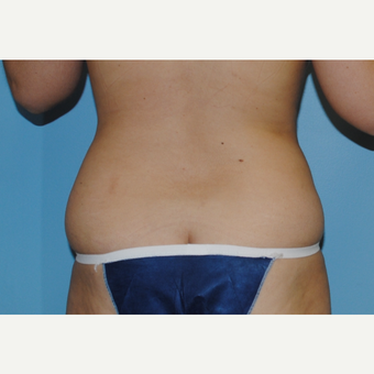 26 Year old with liposuction of her abdoemn and love handles before 3142634