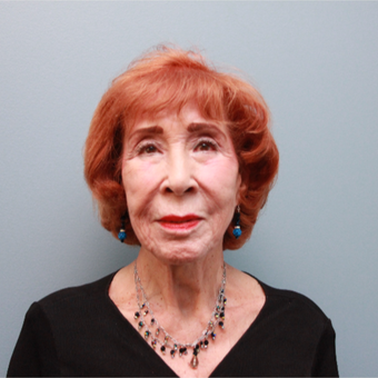 83 year old woman treated with a Facelift before 3544472