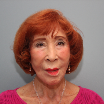 83 year old woman treated with a Facelift after 3544472