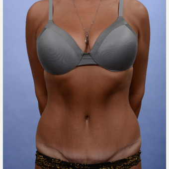 Tummy Tuck after 3052362