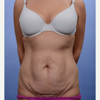Tummy Tuck before 3052362
