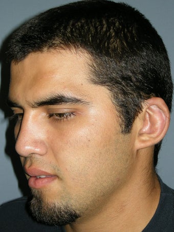 Otoplasty/Ear Surgery 731982