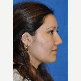 25-34 year old woman treated with Rhinoplasty after 3248059