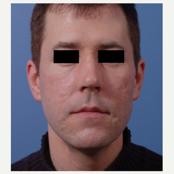 35-44 year old man treated with Acne Scars Treatment after 3749302