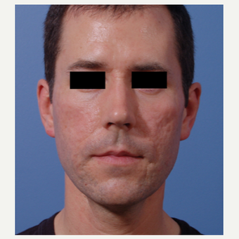 35-44 year old man treated with Acne Scars Treatment before 3749302
