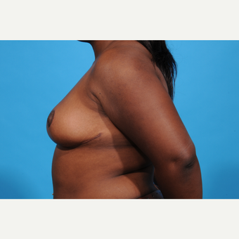 25-34 year old woman treated with Breast Reduction after 3777005