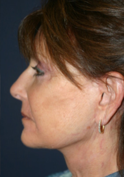 65-74 year old woman treated with Facelift after 1669992