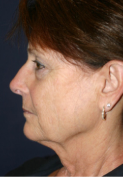 65-74 year old woman treated with Facelift before 1669992