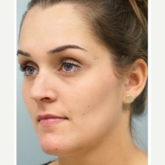 25-34 year old woman treated with Revision Rhinoplasty before 3686803