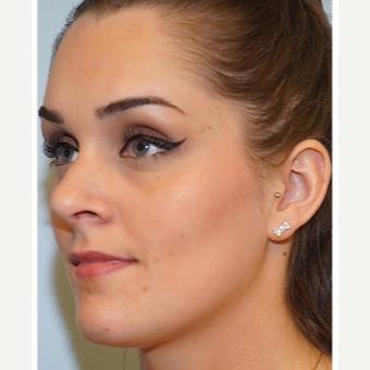 25-34 year old woman treated with Revision Rhinoplasty after 3686803