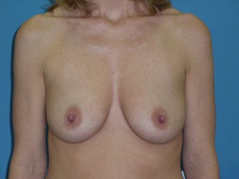 Breast Lift/Augmentation before 611041