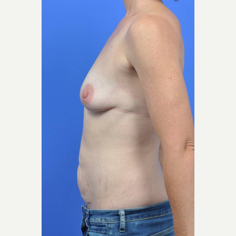 35-44 year old woman treated with Breast Implant Removal before 3289209