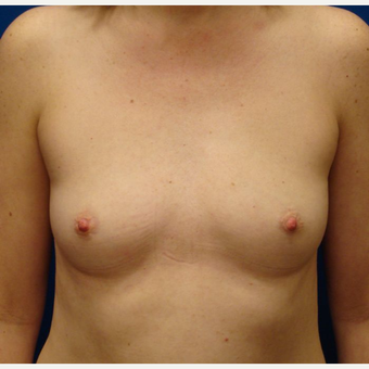 35-44 year old woman treated with Breast Implants before 3671001