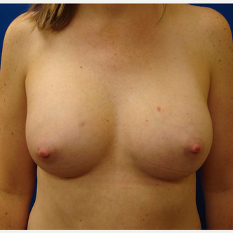 35-44 year old woman treated with Breast Implants after 3671001