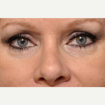 Liquid Rhinoplasty – Injectable Fillers after 3691700