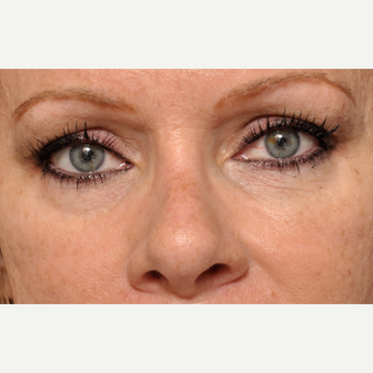 Liquid Rhinoplasty – Injectable Fillers before 3691700