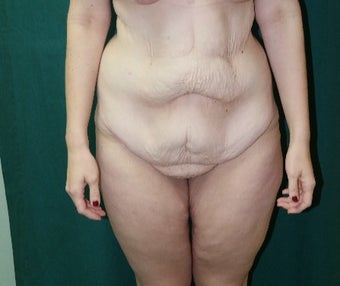 25-34 year old woman treated with Body Lift before 3460083