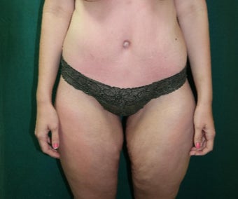 25-34 year old woman treated with Body Lift after 3460083