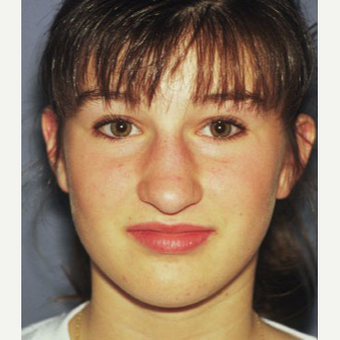 18-24 year old woman treated with Rhinoplasty before 3711448