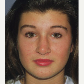 18-24 year old woman treated with Rhinoplasty after 3711448