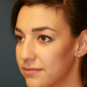 18-24 year old woman treated with Rhinoplasty before 3559775