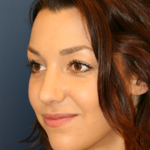 18-24 year old woman treated with Rhinoplasty after 3559775