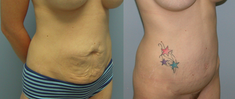 32 Year Old Female Underment a Full Abdominoplasty ( Tummy Tuck) 1139914