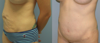 32 Year Old Female Underment a Full Abdominoplasty ( Tummy Tuck) after 1139914