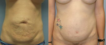 32 Year Old Female Underment a Full Abdominoplasty ( Tummy Tuck) before 1139914