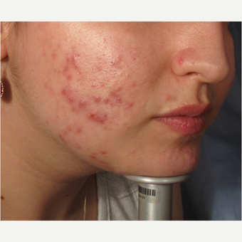 18-24 year old woman treated with Acne before 2997868