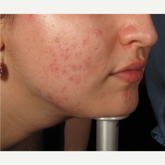 18-24 year old woman treated with Acne after 2997868