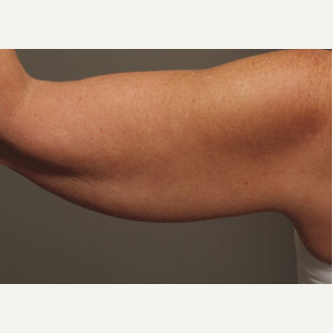 45-54 year old woman treated with Liposuction before 3646576