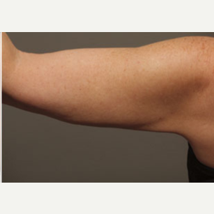 45-54 year old woman treated with Liposuction after 3646576