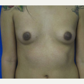 Breast Augmentation before 3054743